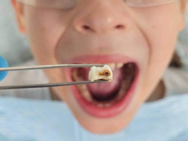 Best Emergency Dental Extractions in San Augustine, TX